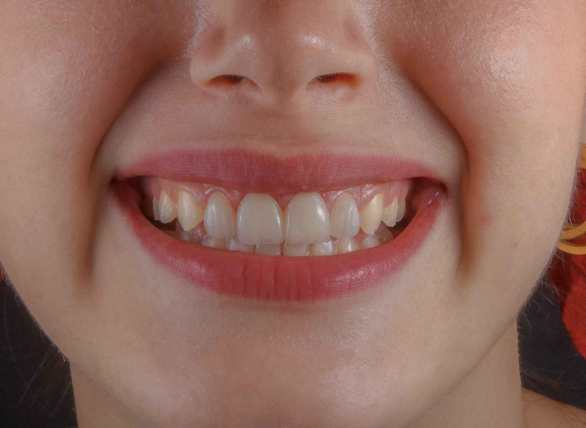 How Long Does Teeth Whitening Last?